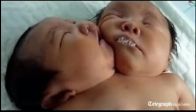 video Çin’de iki başlı kız bebek doğdu!